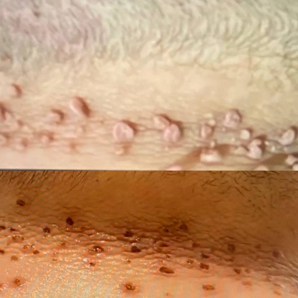 plasma skin tags
